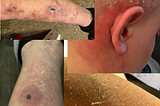 Is GMO food behind this strange skin disease ?