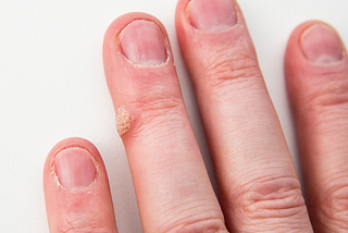 Warts and All: Myths and Misconceptions about Warts