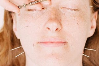 The beauty of Cosmetic Acupuncture