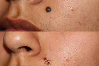 Investigating the Removal of Moles; Understanding How Dermatologists Remove Them