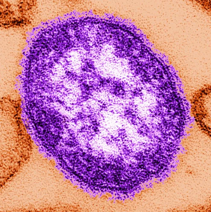 Microscopic image of a single measles virus particle stained in purple, showing its spherical shape and textured surface.